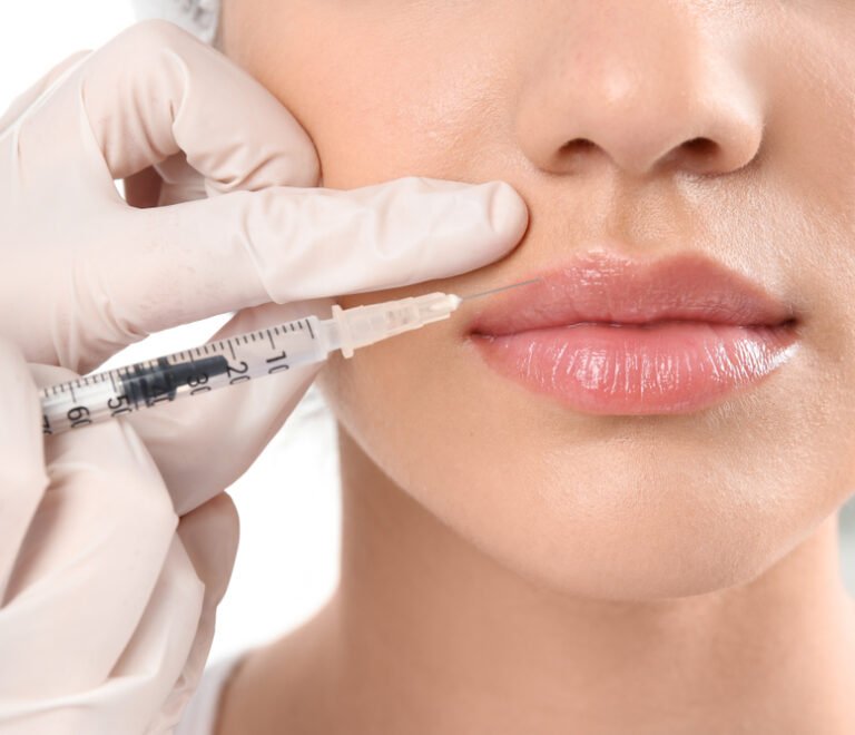 Filler Lèvres